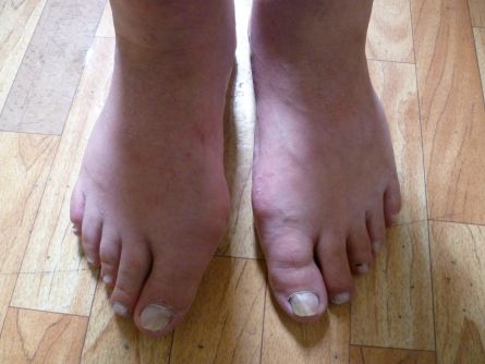 Артрозный hallus valgus